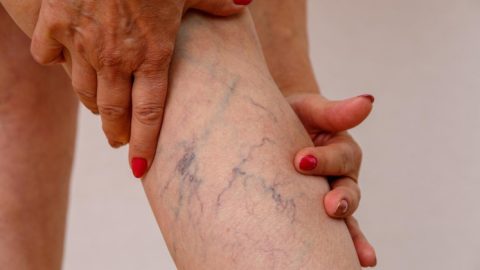 leg with spider veins