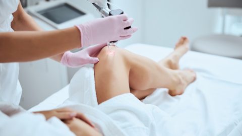 Woman being treated for spider veins
