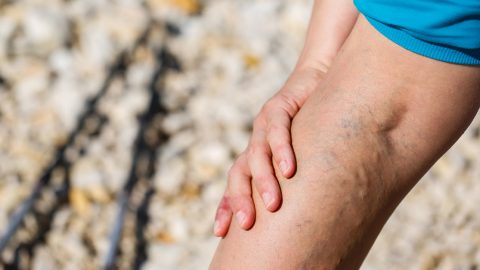 Varicose veins showing up on the back of a person's leg.